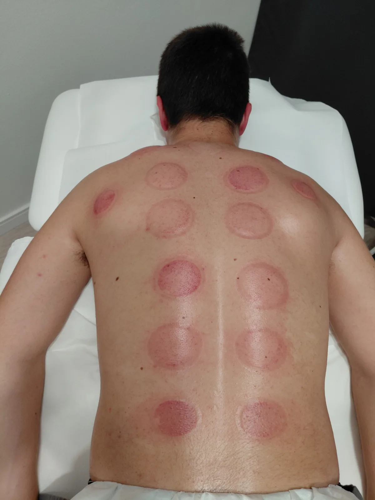 Cupping — detalj čašice